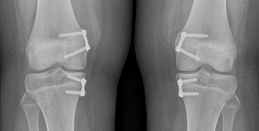 Röntgenbild X-Bein