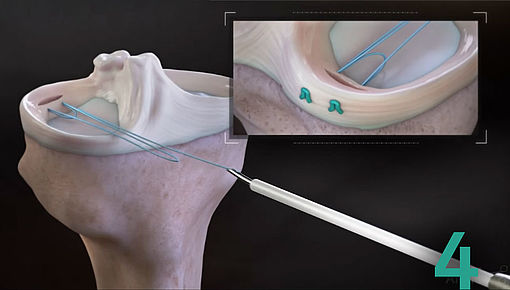 Meniskusnaht 4/5