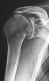 Röntgenbild Schulter prä