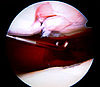 Arthroskopisches Bild eines Kniescheibenknorpeldefektes
