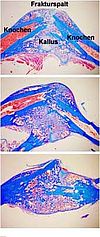 Azan-Färbung eines Frakturkallus von einer Maustibia. Rot angefärbt sind Zellen des Knochenmarks und die Zellkerne des Kallusgewebes