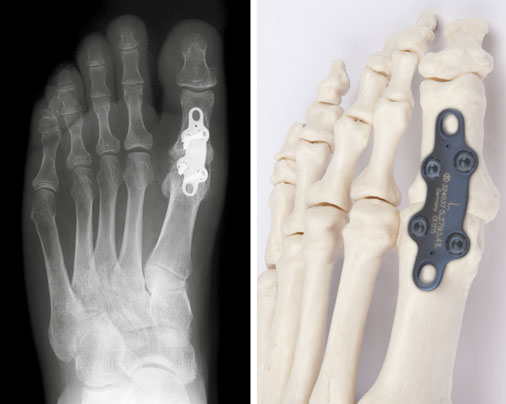 Hallux rigidus Arthrodese