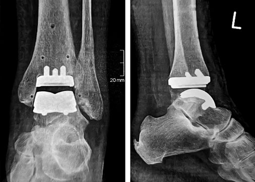 OSG Prothese im Röntgen