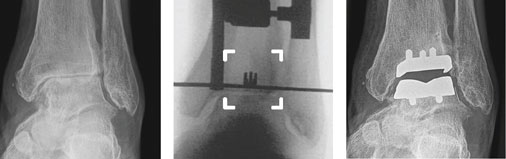 Röntgen OSG Implantat