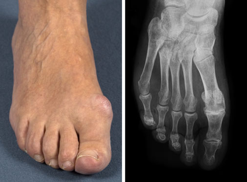 Hallux rigidus