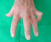 Hand Arthrose