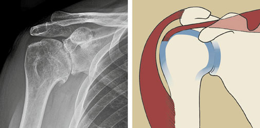 Anatomie des Schultergelenks