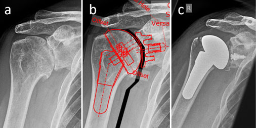 Planung Schultergelenkimplantat