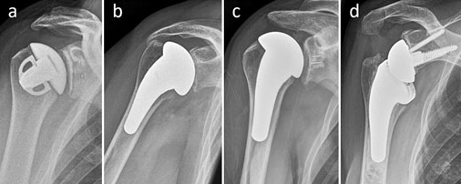Spektrum der Schulterendoprothesen
