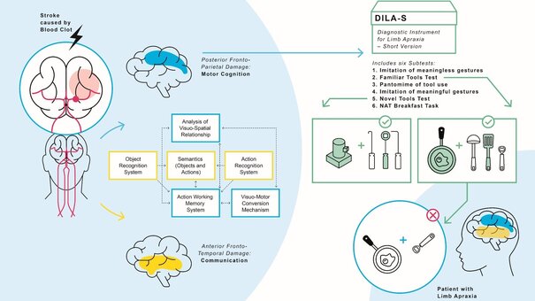 Mit dem Diagnostik Instrument for Limb Apraxia (DILA-S) untersuchen wir neurologische Patienten. Besonders häufig zeigen Betroffene mit linkshemisphärischem Schlaganfall oder Demenz apraktische Symptome. Die Apraxie ist ein sehr heterogenes Störungsbild und kann die Imitation von Handstellungen, das Ausführen von Gesten oder/und den Werkzeuggebrauch beeinträchtigen. Wir konnten beispielsweise zeigen, dass Schädigungen in unterschiedlichen Hirnregionen mit Problemen im Umgang mit unbekannten Werkzeugen versus im Umgang mit bekannten, alltäglichen Werkzeugen einhergehen. 