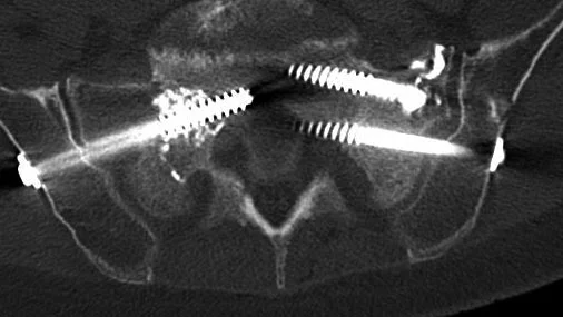 Kreuzbeinbruch und Verschraubung (CT)