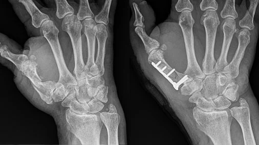 Trümmerbruch des 1. Mittelhandstrahls