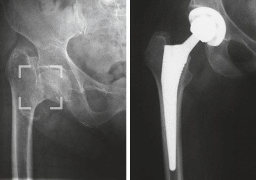 Röntgenaufnahmen eines abgerutschten Schenkelhalsbruches mit vorbestehender Arthrose des Hüftgelenks und nach operativer Versorgung mittels neuen Gelenks