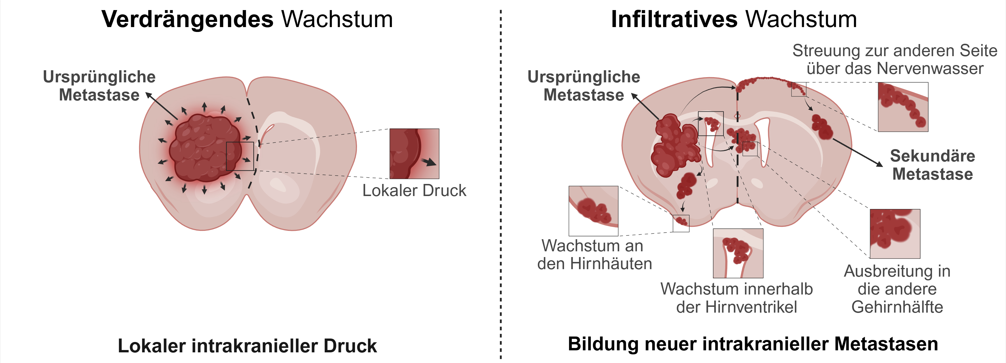 wissenschaftliche Grafik zum Thema Metastasen